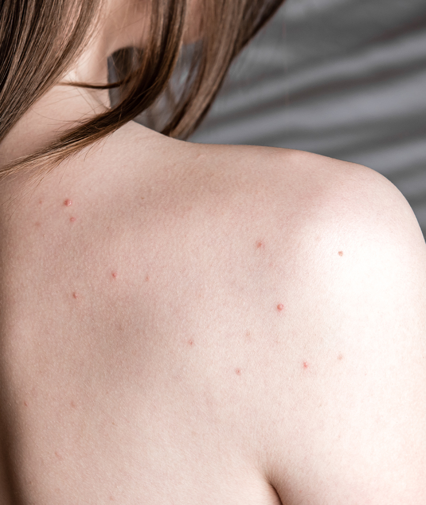 Photo of a woman's bare shoulder with some small red blemishes