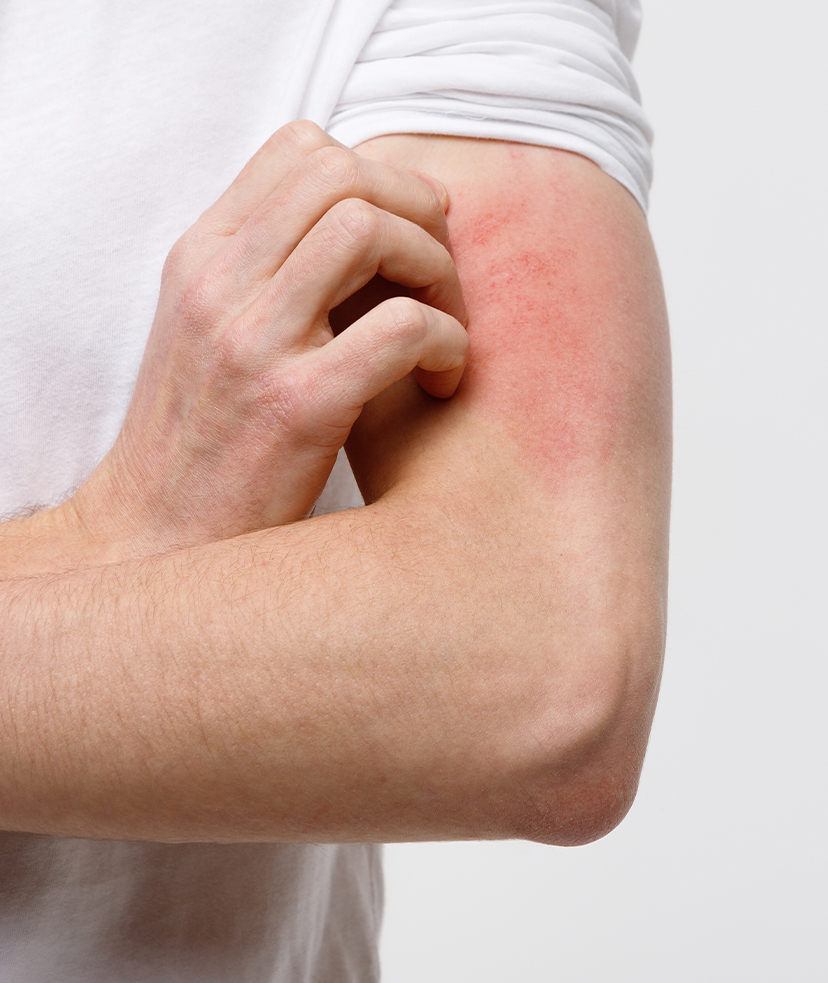 Photo of a man's hand scratching a rash on his opposite arm