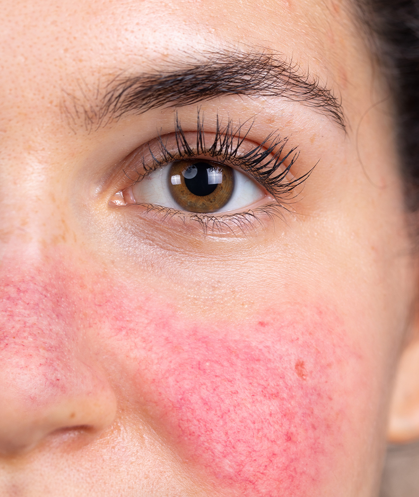 Close-up photo of a woman's brown eye and rosacea on her cheek and nose