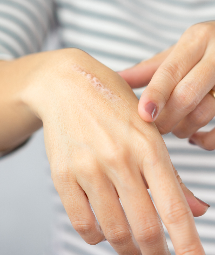 Photo of a scar on a woman's hand