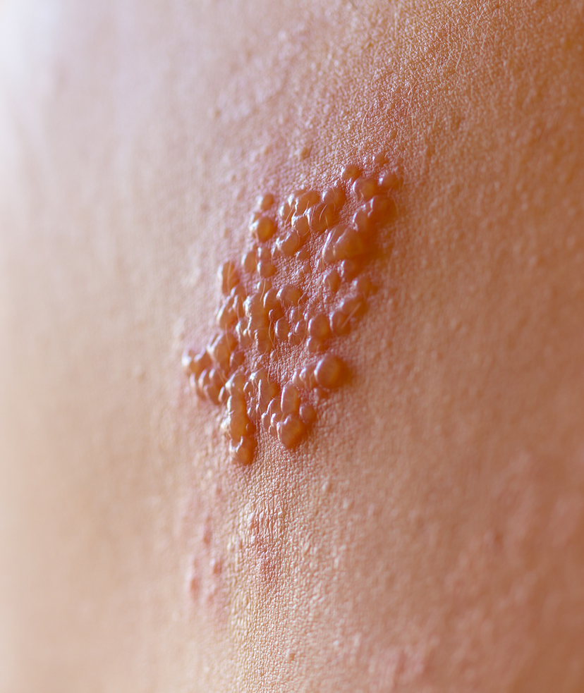 Photo of a shingles rash on a person's skin