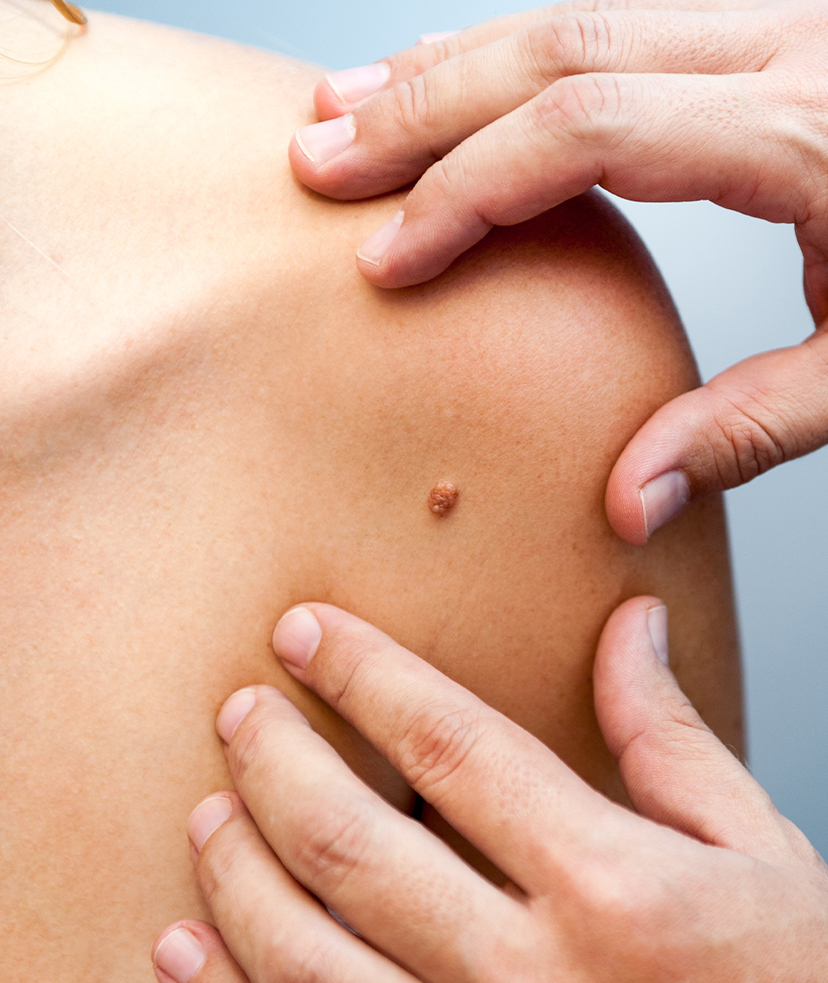 Photo of a potential skin cancer mole on a person's body