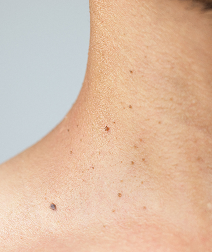 Photo of small skin tags on a person's neck