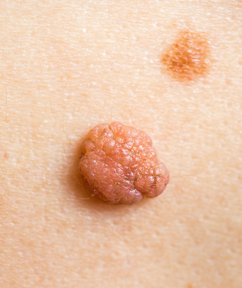 Close-up photo of a skin tag