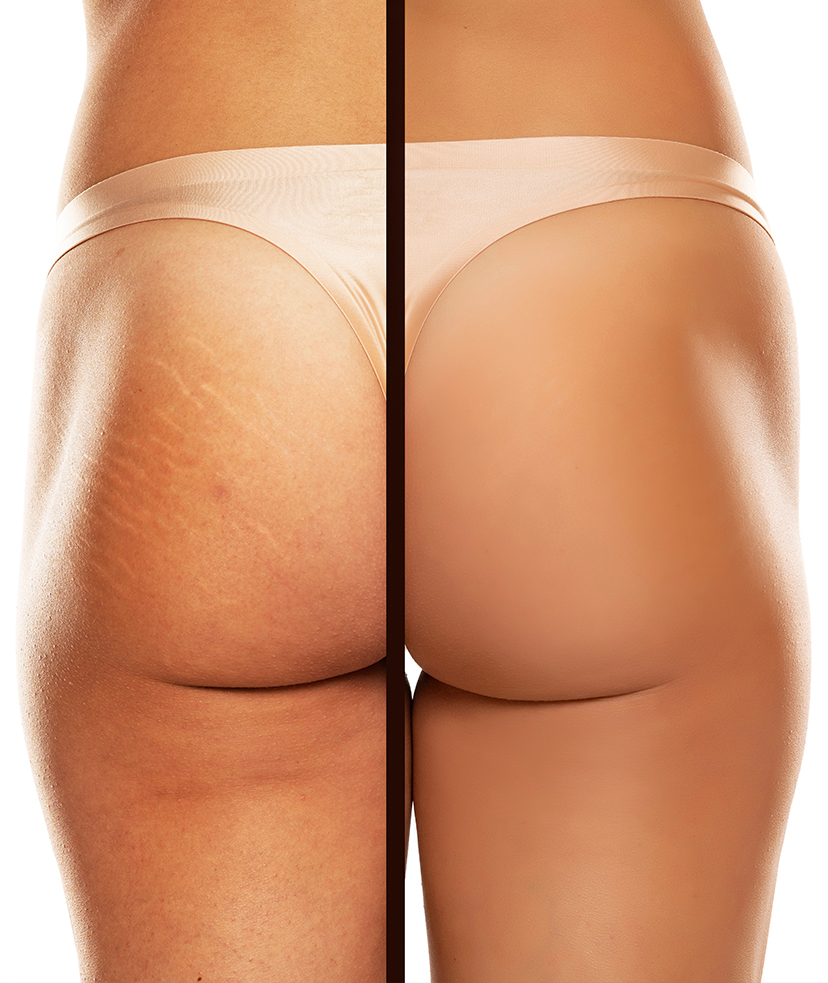 Side by side photos of a woman's buttocks before and after stretch mark treatments