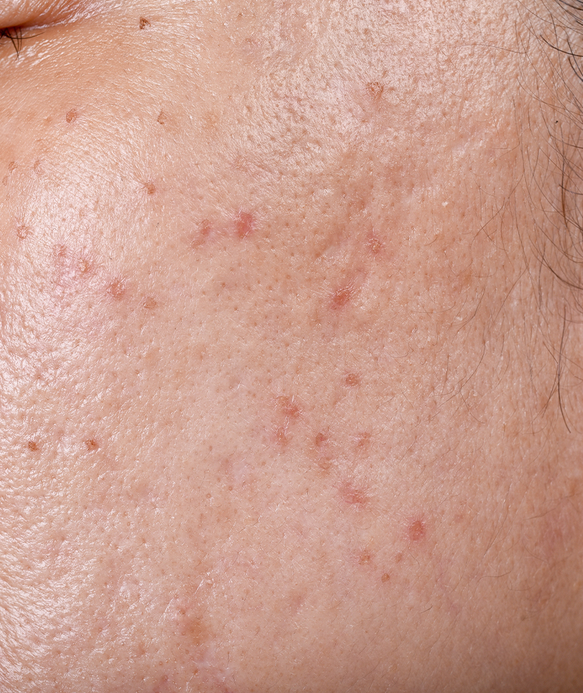 Photo of acne scars on a woman's face