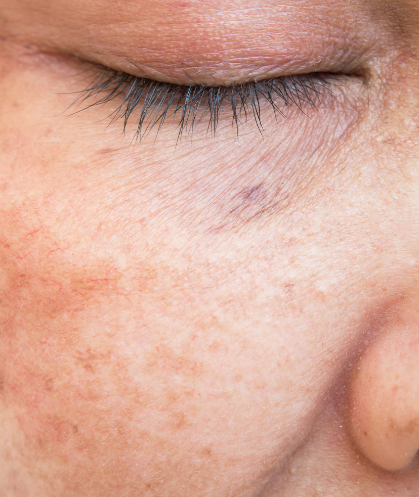 Photo of sun damage on a woman's face