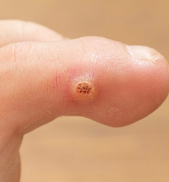 Photo of a wart on a person's toe