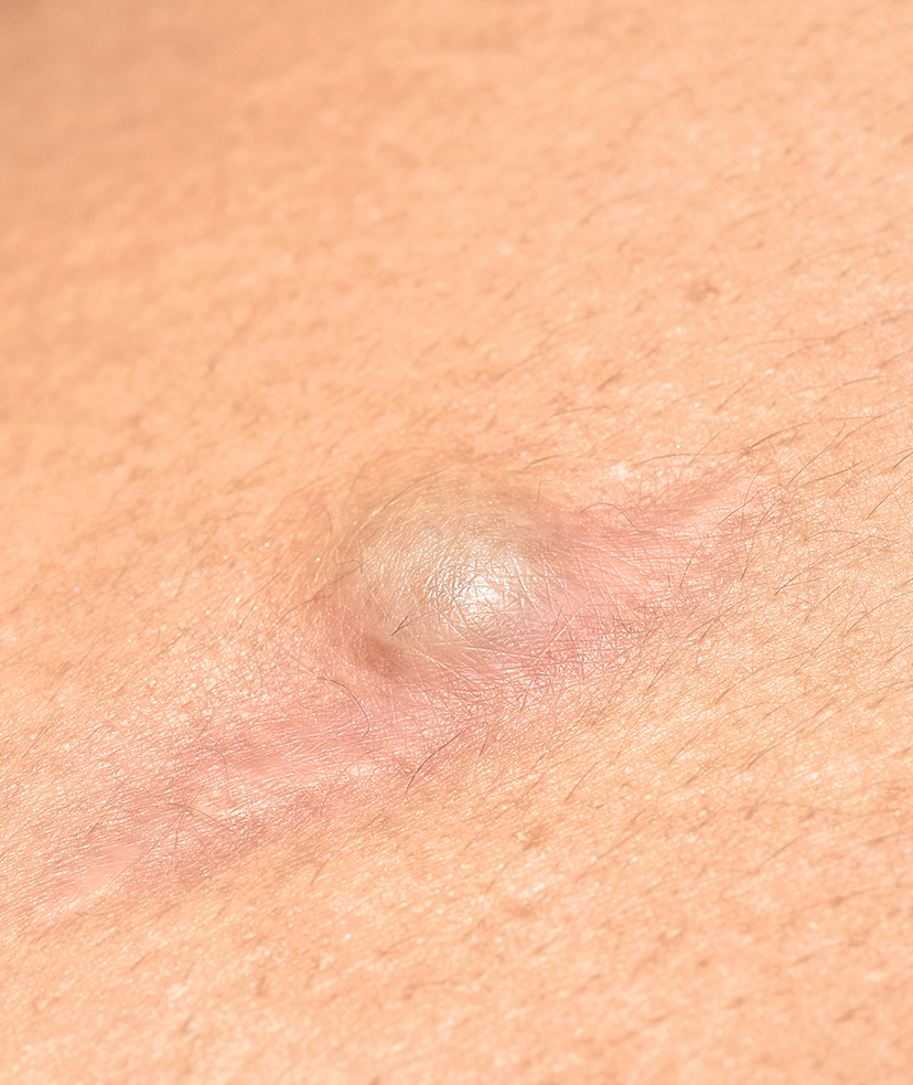 Photo of a cyst on a person's skin