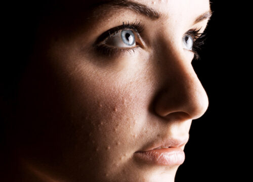 Photo of a woman's face, partially in shadow. She has acne on her cheek.
