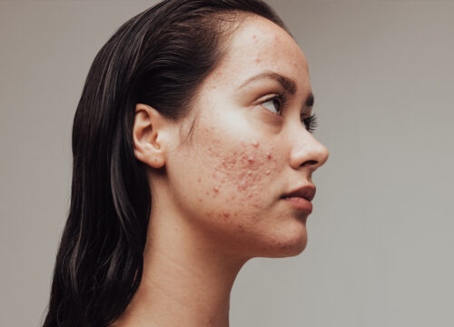 Photo of a woman with acne scars and pimples on her face