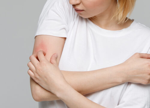 Photo of a woman scratching an allergic reaction rash on her arm