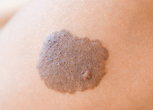 Photo of a birthmark on a person's skin
