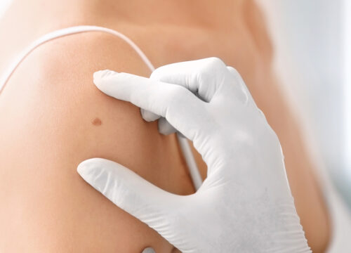 Photo of a dermatologist checking a spot on a patient's shoulder