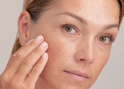 Photo of a woman with brown spots and freckles on her face