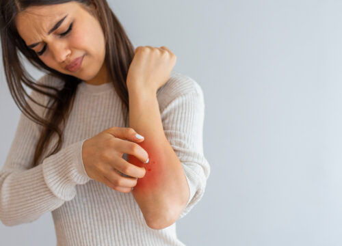 Photo of a woman with dermatitis scratching her elbow