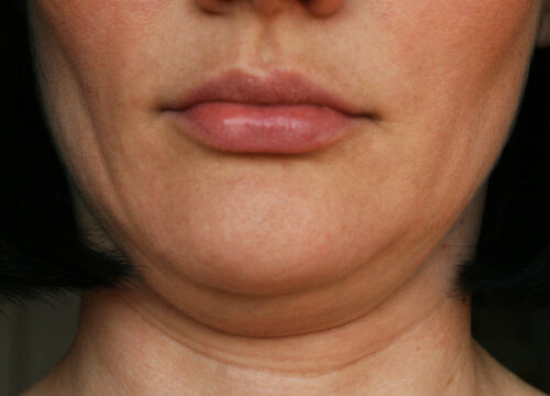 Photo of a woman's double chin