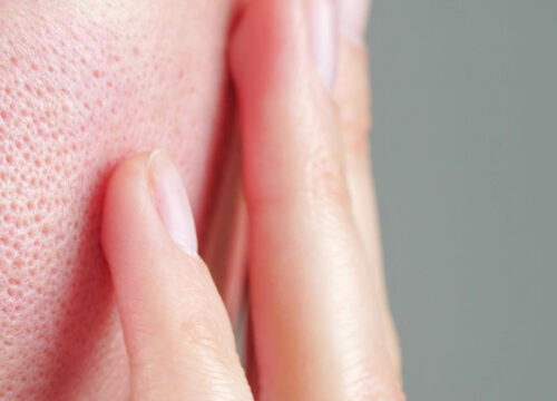 Photo of enlarged pores on a woman's cheek