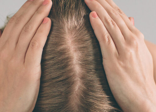 Photo of a woman's head. She is experiencing hair loss.