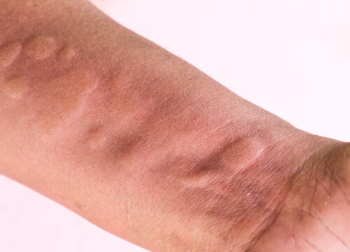 Photo of hives on a person's arm