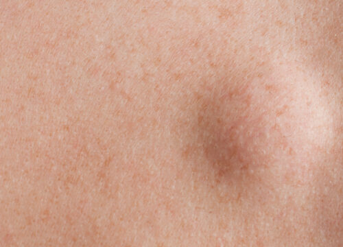 Photo of a lipoma on a person's skin