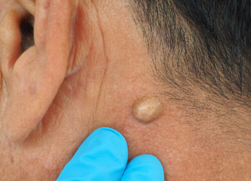Photo of a lipoma on a person's neck