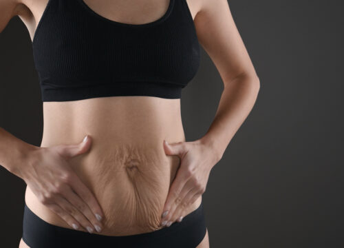 Photo of a woman touching the loose skin on her abdomen