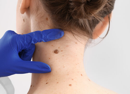 Photo of a dermatologist inspecting a mole on a woman's neck