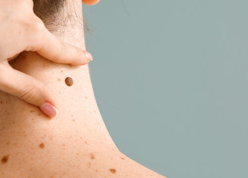 Photo of a a mole on the back of a woman's neck