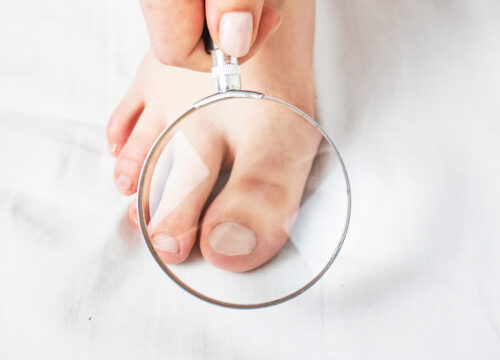 Photo of a person's toenail being looked at with a magnifying glass by a dermatologist