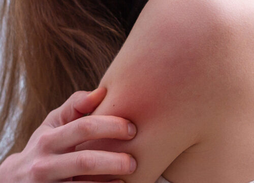 Photo of a psoriasis rash on a woman's arm