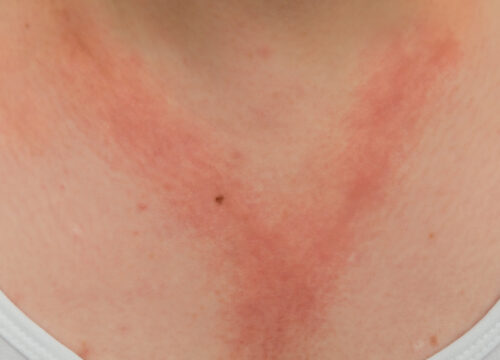 Photo of a rash on a woman's décolleté