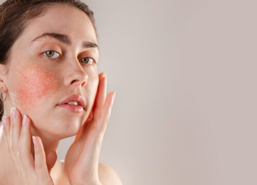Photo of a woman's face with rosacea on her cheek