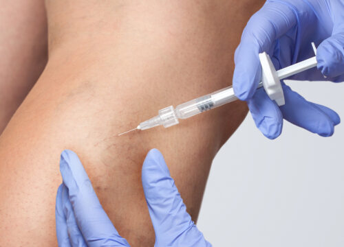 Photo of a man receiving sclerotherapy treatments