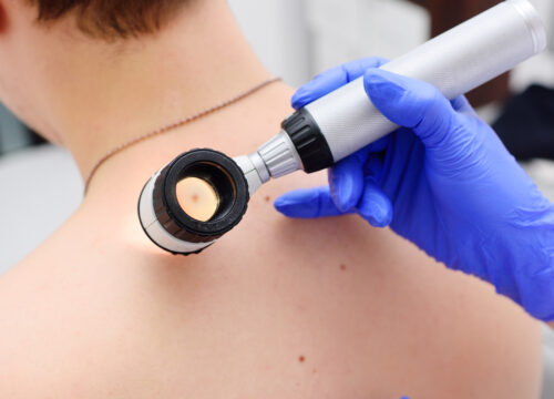 Photo of a dermatologist checking a male patient for skin cancer