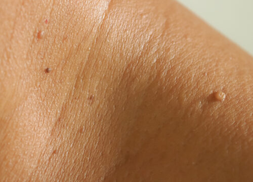Photo of skin tags on a person's body