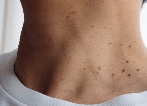 Photo of skin tags on a man's neck
