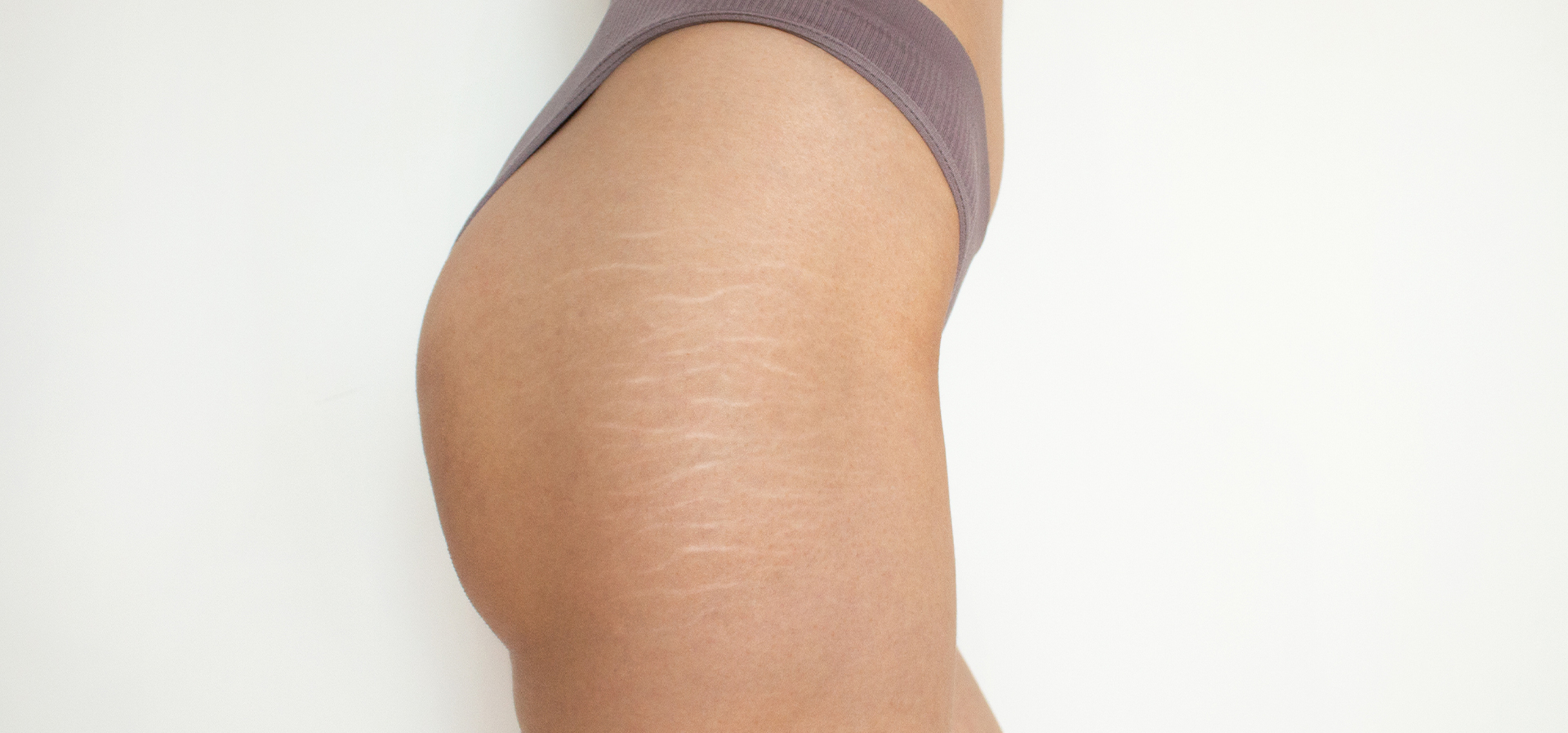 Stretch Marks Treatment - The Center for Women's Aesthetics