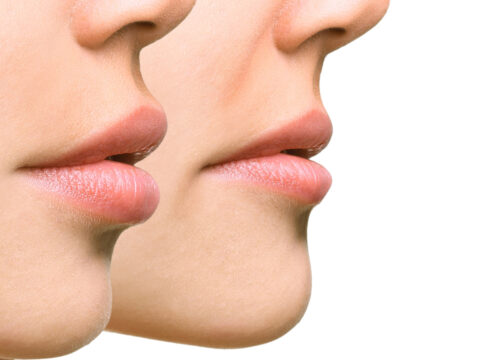 Photo of two women's lower faces side-by-side
