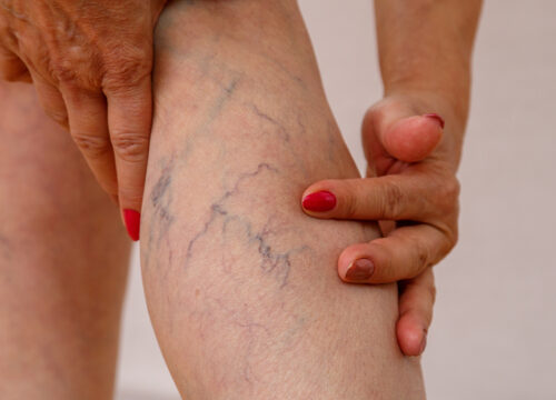 Photo of varicose veins on a woman's leg