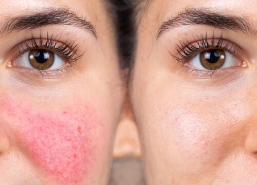 Photos of a woman's cheek before and after rosacea treatments