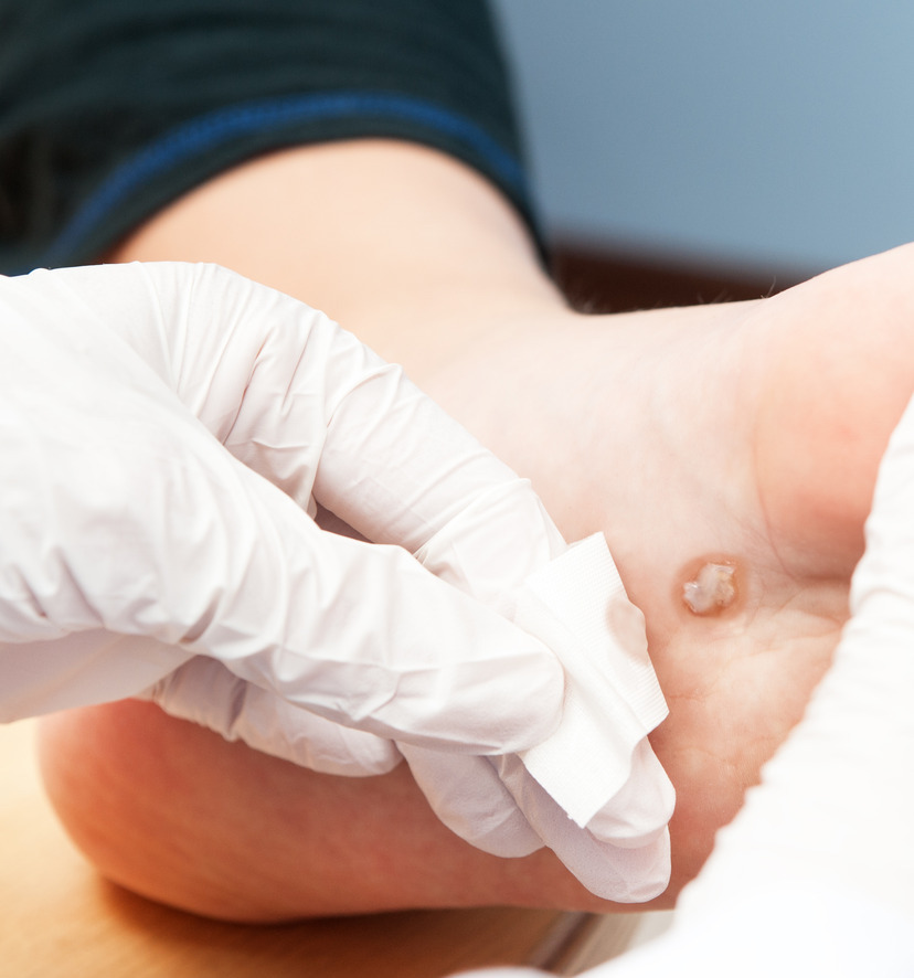 Photo of a doctor treating a patient's wart