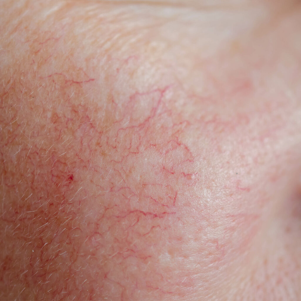 Close-up photo of broken blood vessels on a person's skin