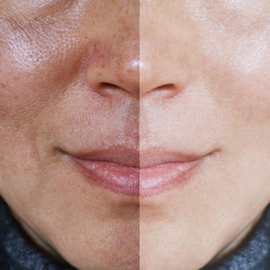 Side-by-side photos of a woman's face with and without melasma