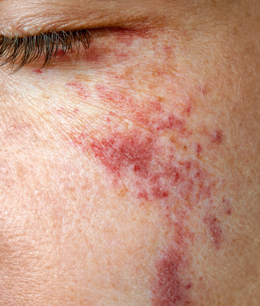 Photo of a birthmark on a woman's cheek