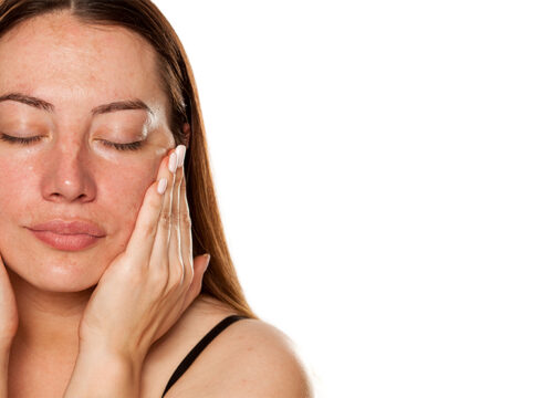 Photo of a woman with discolored skin on her face