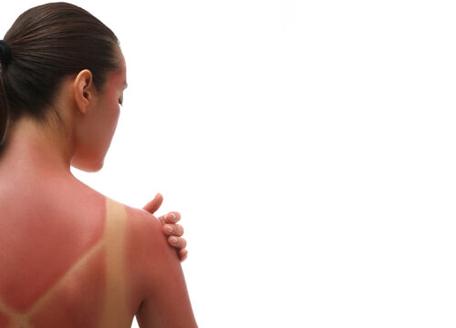 Photo of a woman with sun damage on her back