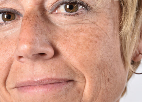 Photo of a woman with hyperpigmentation on her face