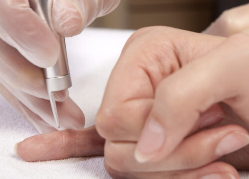 Photo of a dermatologist performing wart removal on a patient's finger