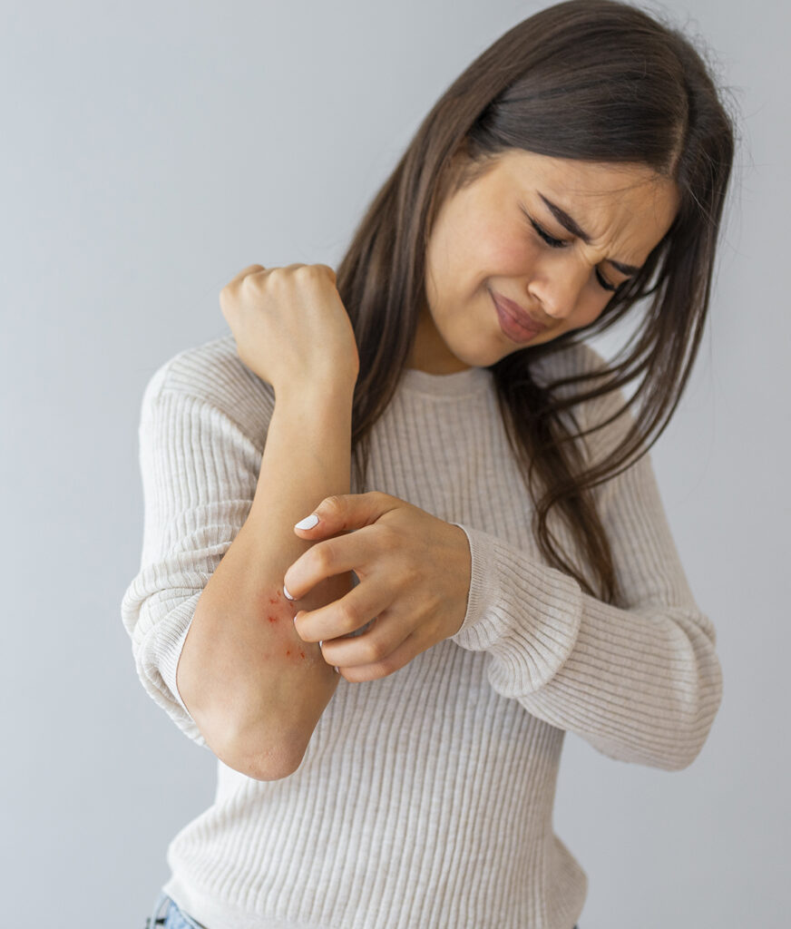 Photo of a woman scratching an eczema rash on her arm